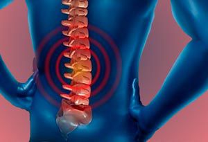 Hernias discales 6 hernia-discal