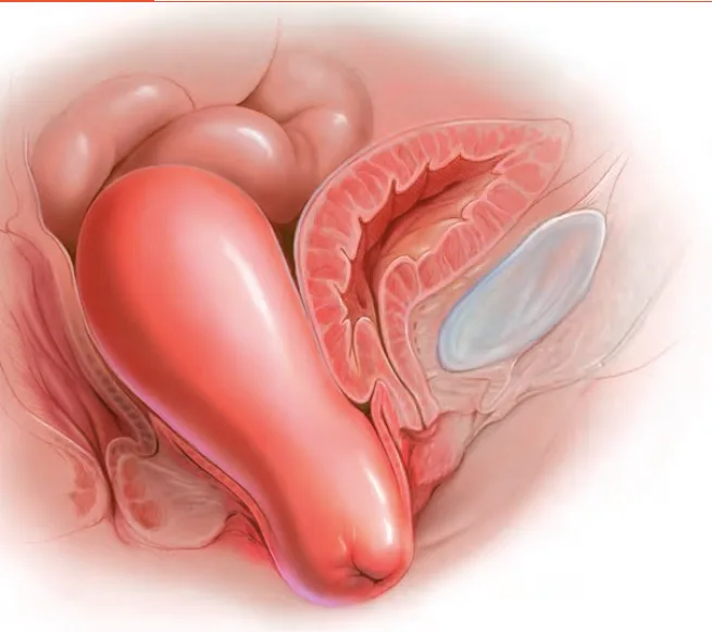 ¿Pesadez o Sensación de bulto en la vagina? POP 1